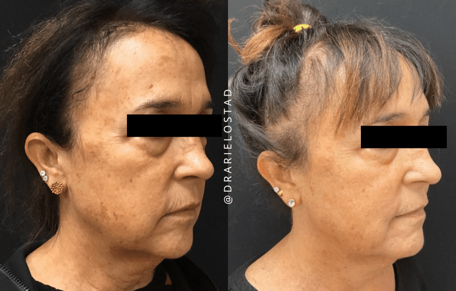 can glutathione cure melasma Treating Melasma Orally – The Easy Way to Clear Skin