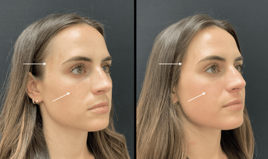 Treating Melasma Orally – The Easy Way to Clear Skin