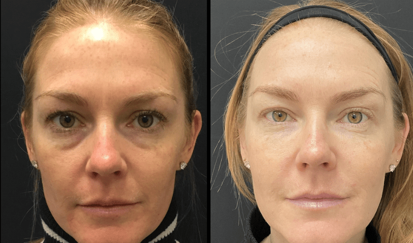 Benefits of Using Fillers After Weight Loss